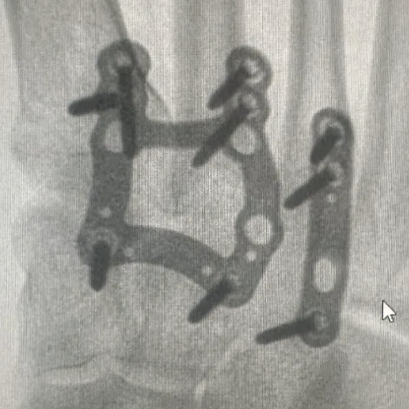 Bones